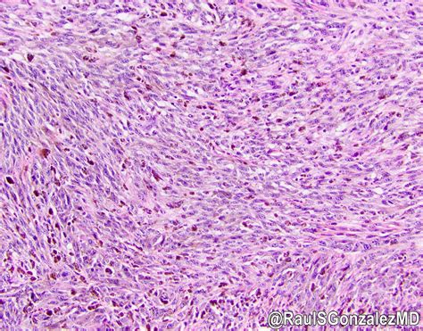 melanoma markers pathology outlines